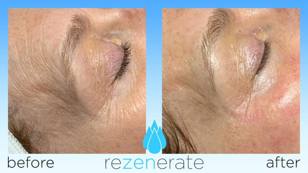 Rezenerate Nano Facial Nanoneedling, Microchannel, Facial, Antiaging, Firming, Shelton WA, Mason County