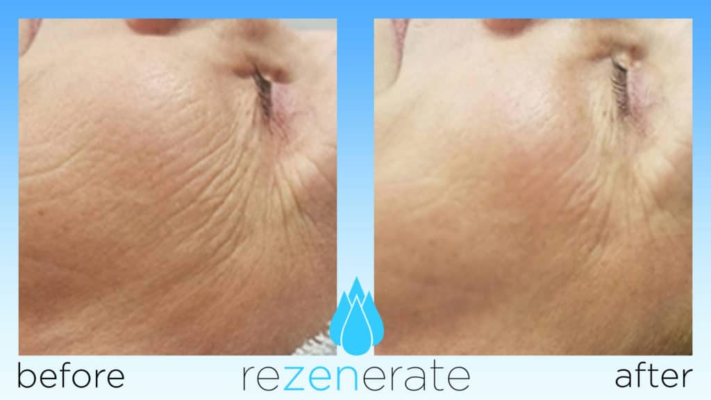 Rezenerate Nano Facial Nanoneedling, Microchannel, Facial, Antiaging, Firming, Shelton WA, Mason County