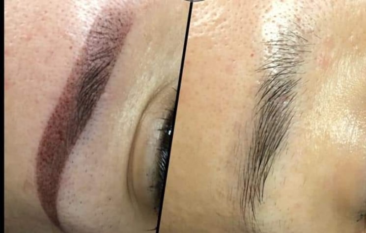 emergency-removal-microblading-eyebrows-saline-shelton-olympia-wa
