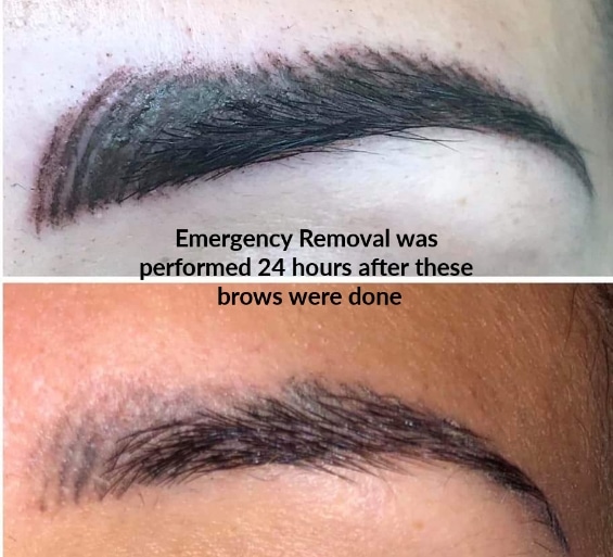 saline-tattoo-emergency-removal-microblading-permanentmakeup-shelton-washington